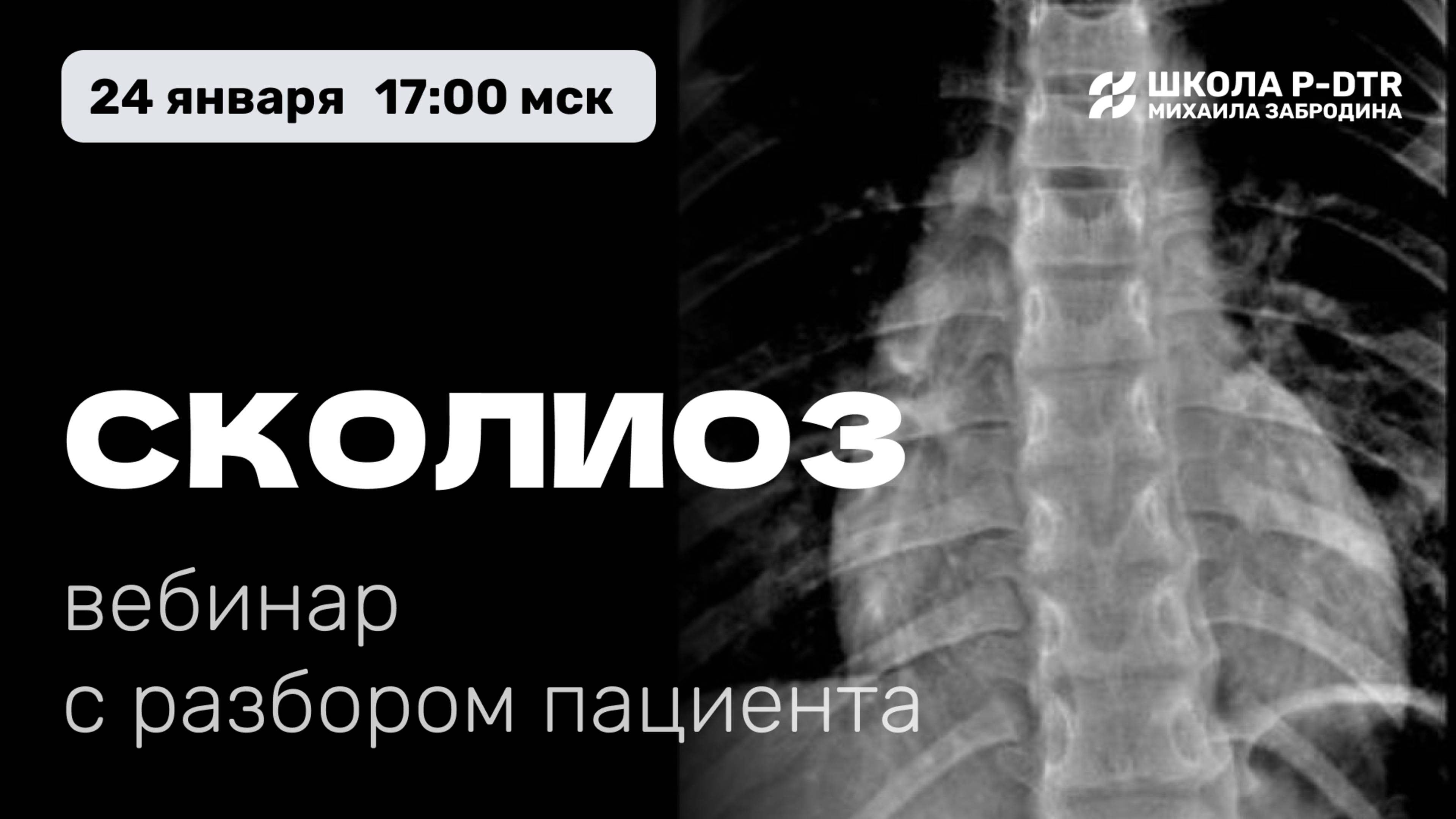 Бесплатный вебинар СКОЛИОЗ с врачом Александром Атякшевым