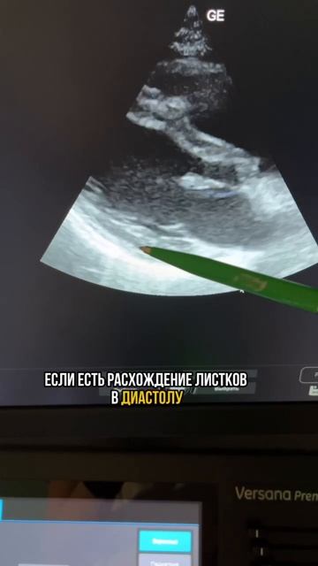Гидроперикард по ЭхоКГ! Самая частая ошибка!