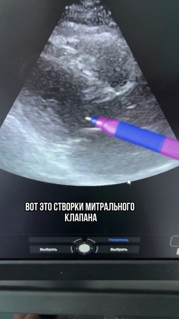 Была Ангина и Ревматизм. Как это видно по СЕРДЦУ?