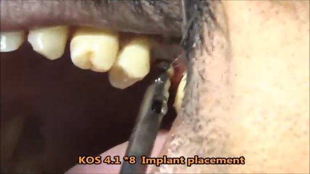 Maxillary first molar   close to sinus   using short KOS implant