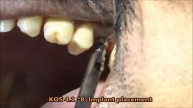Maxillary first molar close to sinus using short KOS implant