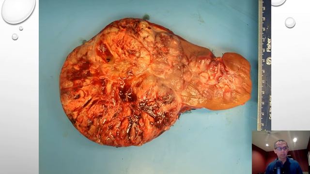 MiT Family Translocation Renal Cell Carcinoma