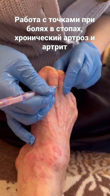 Стопы. Артрит и артроз, деформации стоп