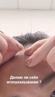Иглоукалывание. Делают ли себе иглоукалывание мастера рефлексотерапии ?