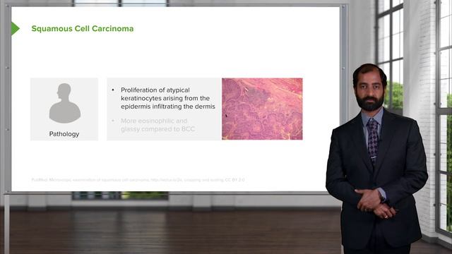 04. Squamous Cell Carcinoma (SCC, Squamous Cell Cancer)