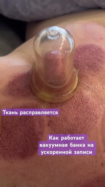 #вакуумныймассаж #массаж #иглоукалывание