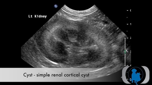 Simple renal cortical cyst