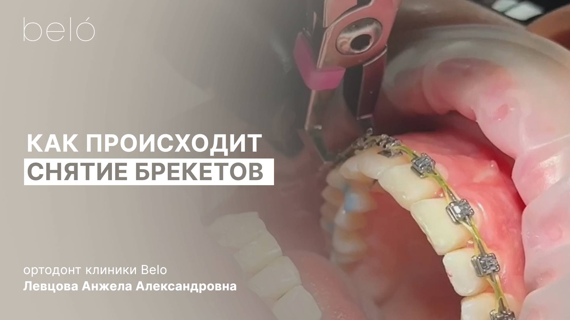 Процесс снятия брекетов в стоматологии Belo