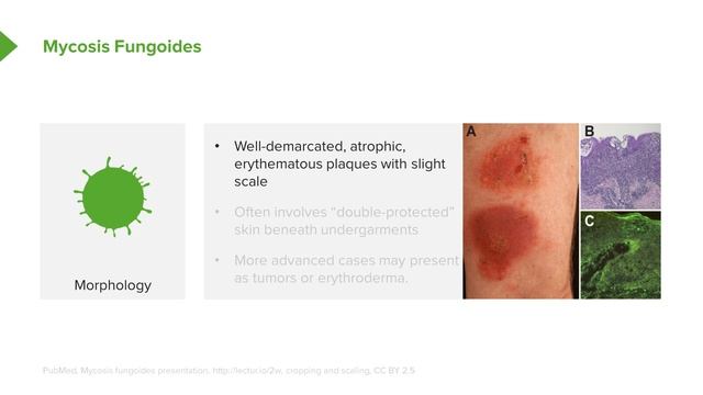 05. Mycosis Fungoides