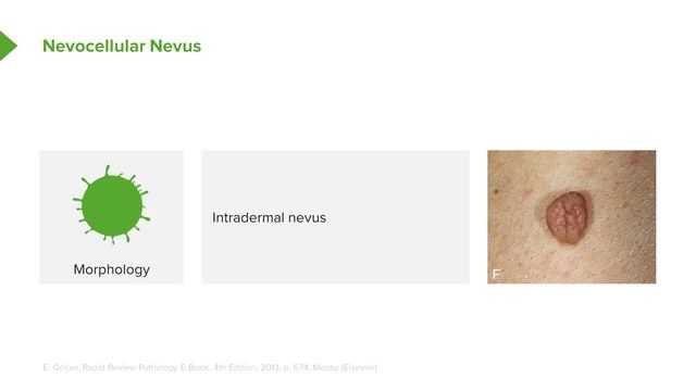 06. Benign Nevus and Dysplastic Nevus