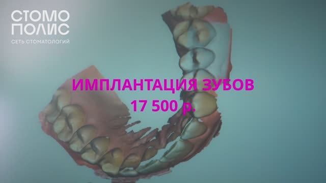 Имплантация за 17.500 руб. MEDENTIKA (Германия) - немецкое качество!