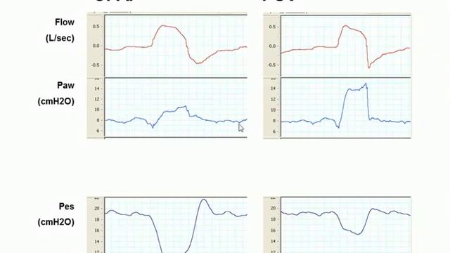 Assess patient's effort during assisted mechanical ventilation A Pesenti 2014