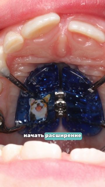 Расширили место под постоянные зубы