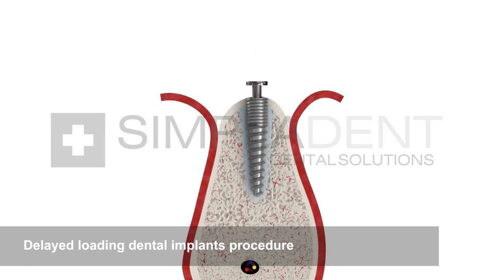 Delayed loading dental implants procedure  Simpladent Симпладент
