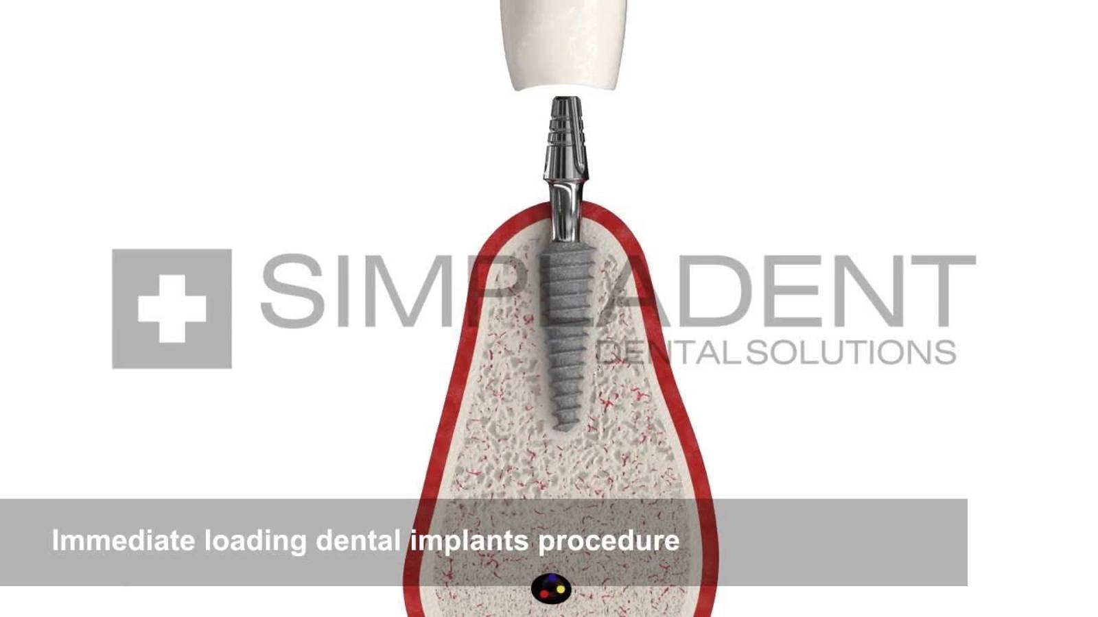 Immediate loading dental implants procedureСимпладент