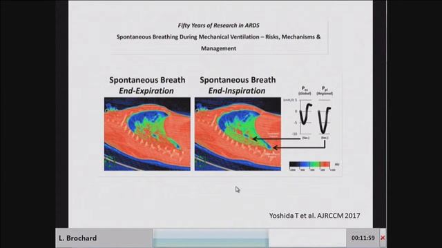 PRO INVASIVE VENTILATION IS IT BENEFICIAL IN ARDS Laurent Brochard 2017