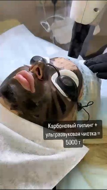 Карбоновый пилинг + ультразвуковая чистка = 5т
#карбоновыйпилинг #косметологмарьино