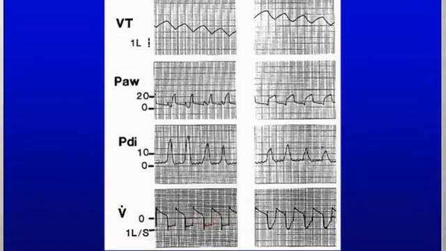 Patient Vent interactions L Brochard 2004