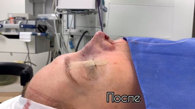 Ринопластика
