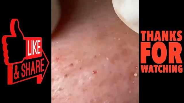 blackheads remove,pimples removal,acne removal treatment,dr pimple popper nose 2021 #16