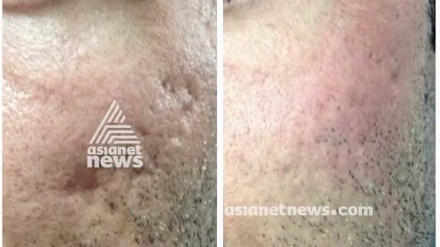 Laser Treatment for skin  | ലേസര് ചികിത്സ | Doctor Live 9 April 2018