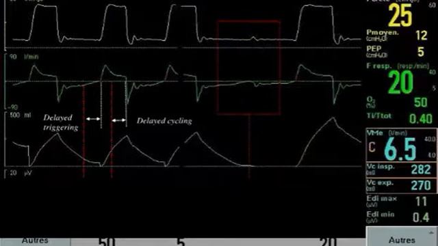 21 P V Asychrony Bochard L (2010)