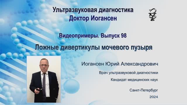 УЗИ. Доктор Иогансен. Видеопримеры. Выпуск 98. Ложные дивертикулы мочевого пузыря.