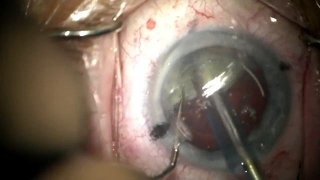 Femto Laser Assisted Cataract Surgery