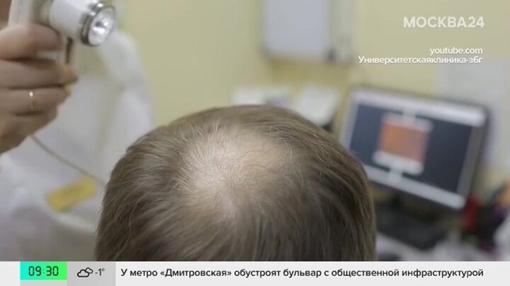 Подростки в России начали массово терять волосы
