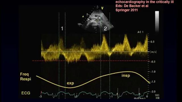 VA ECMO 1 De Backer Daniel
