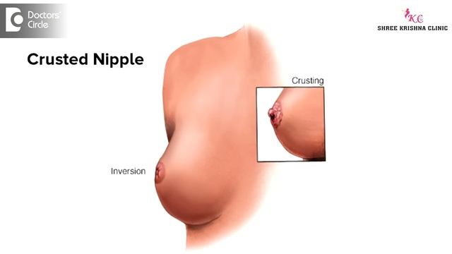 What causes breast pain with itchy nipples? - Dr. Shailaja N