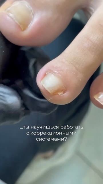 Титановая нить в подологии и педикюре