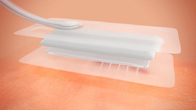 PICO Mechanism of Action - Surgical Incisions
