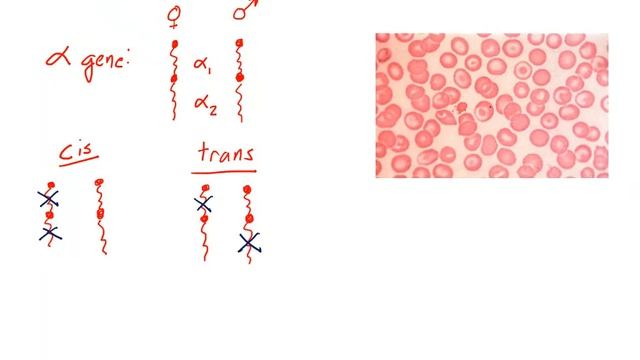 anemia