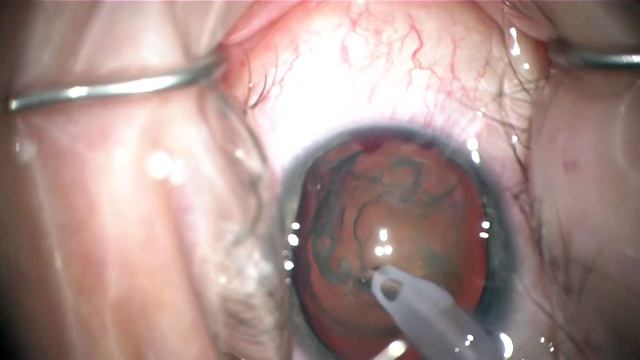 phacotrabectome in advanced pigment dispersion glaucoma; young high myope, iris lens instability