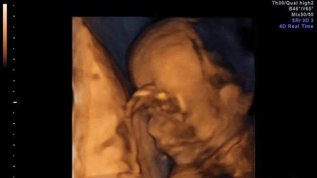 Dancing Baby In Ultrasound Video