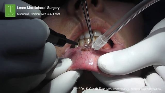 Excision of Fibroma Lip with Co2 Laser