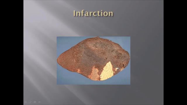 Infarction