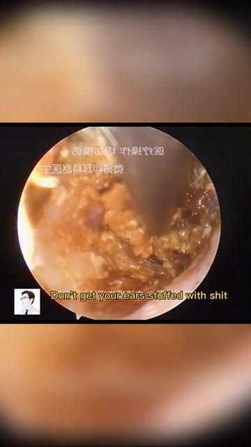 Best Ear Wax Removal & Extraction with Vacuum Remover 真空リムーバーによるにきびの除去と抽出 12