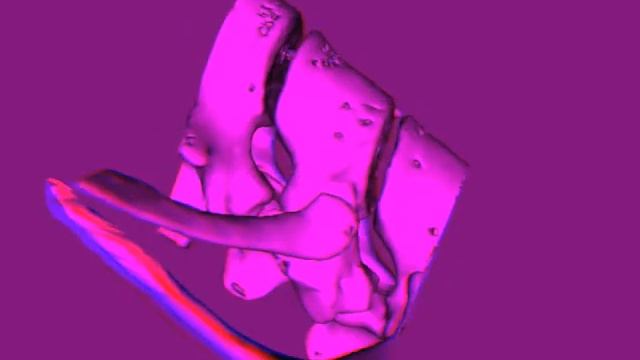 Anaglyph 3D TAC