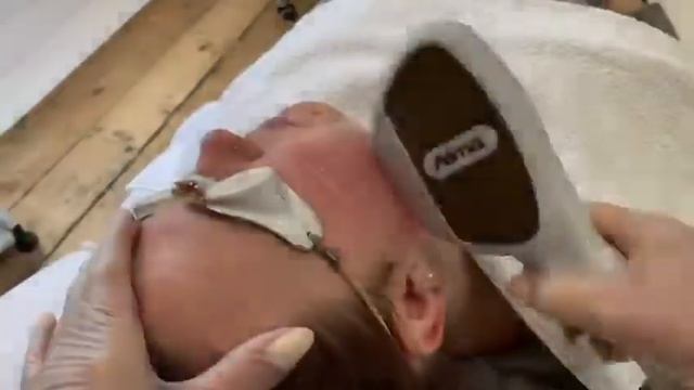 Harmony XL Pro Laser Treatment