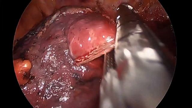 UNIPORTAL LEFT S6 SEGMENTECTOMY