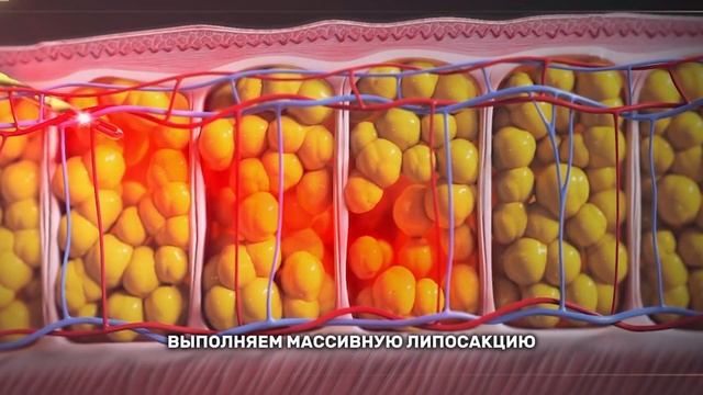 ЛИПОСАКЦИЯ, КАК СПОСОБ СНИЖЕНИЯ ВЕСА