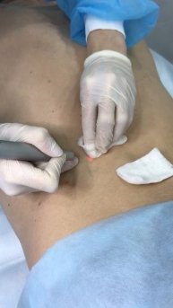 Лазерное удаление новообразований #Shorts