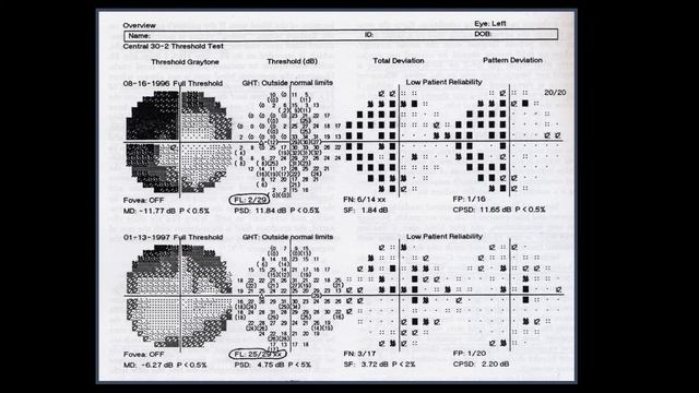 3- Visual field interpretation (Reliability indices in Humphrey perimeter).