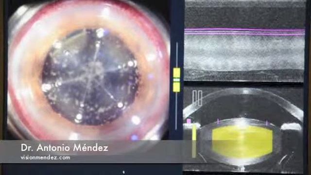 Cirugía de Catarata con Láser de Femtosegundo.