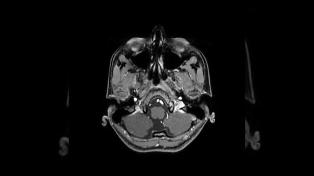 fungal tuberculoma brain