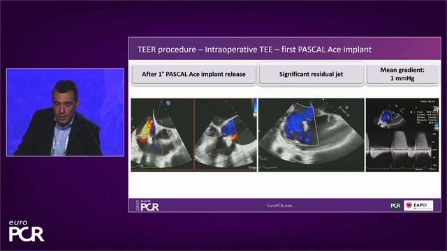 Tailoring tricuspid regurgitation patient treatment with the PASCAL Precision system - EuroPCR 2023