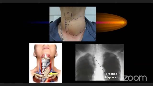 SEM Online Master Class -UG Surgery : Module 6 - Approach to Thyroid Swellings