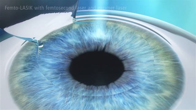 Femto LASIK Treatment Animation